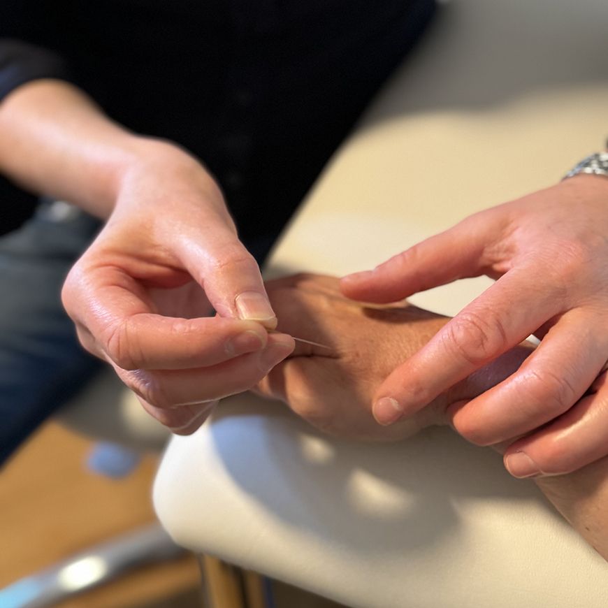 Eine Akupunkturnadel wird gesetzt.